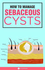 14 Home Remedies To Treat Sebaceous Cysts Cysts Home Remedies Health