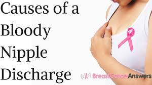 As its name suggests, inflammatory breast cancer (ibc) often causes the breast to become red, swollen, and inflamed. Bloody Nipple Discharge What Are The Causes Youtube