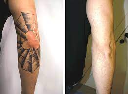 It's a great time to have your unwanted tattoos removed. Lasers Make Their Marks On Skin And Tissue Procedures Features Aug 2015 Biophotonics