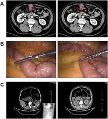 Image result for Adynamic Ileus