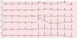 Physiological and pathological q waves#ecg interpretation Prague Icu