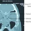 In this process, a small nasal polyps nasal polyps are soft and painless benign growths on the lining of the sinuses and nasal passages. Https Encrypted Tbn0 Gstatic Com Images Q Tbn And9gcshhnnm2gtnbekd64skls Udqboz3nm Ujhlsfjgqm Usqp Cau