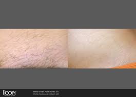 Laser hair removal destructs the hair follicle by using pulsed energy that is attracted to the dark melanin in the hair shaft. Laser Hair Removal Chicago Il Chicago Breast Body Aesthetics