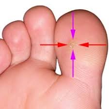 Foot warts are usually on the soles (plantar area) of the feet and are called plantar warts. Plantar Wart Information