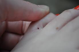 (if it does happen, then remove the parts with the tweezers.) 3. Ticks Everything You Never Wanted To Know But Need To The Buckit Blog