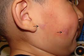 A Toddler With Facial Nodules A Case Of Idiopathic Facial Aseptic Granuloma