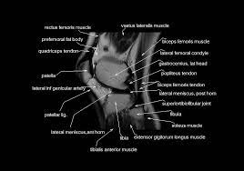 Sagittal view is the basis for knee mri including acl evaluation. Mri Knee Anatomy Knee Sagittal Anatomy Free Cross Sectional Anatomy Mri Knee Mri Medical Radiography