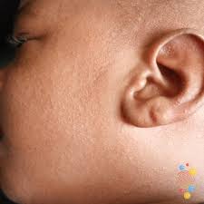 Image result for scabies human children