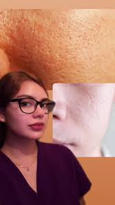 TEXTURA EN PIEL ( poro dilatado ) . . . #cacarizos #porodilatado #poro...