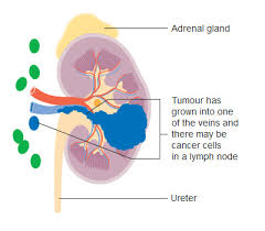 The most common symptoms tend to show up in the lower back area or are evident in urine. Kidney Cancer Causes Diagnosis Treatment Myrtle Beach Sc