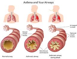 Asthma is a chronic disease of the respiratory system that causes narrowing of the airways resulting in shortness learn more about the symptoms, causes, diagnosis, and treatment of asthma at webmd. Asthma