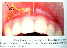 Image result for Field Block