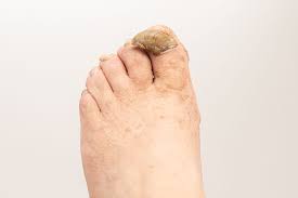 Image result for Onychogryphosis feet
