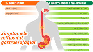 Simptomatologia bolii de reflux gastroesofagian. Gerdoff