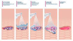 Mrsa most commonly causes relatively mild skin infections that are easily treated. Medigel Wundreinigungsspray Wirkweise