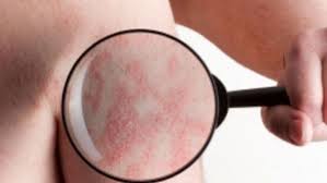 Há alguns anos sofri de psoriase , doença, que na altura em que podia ser bem visível em mim. Psoriase Rosea Alba Versicolor A Psoriase Tem Cura