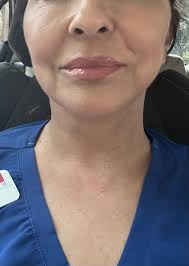 Urgent!!! Please, I need recommendations for an effective scar removal  medicine or gel that someone has tried and it worked. I had an accident and  it has left a big scar on