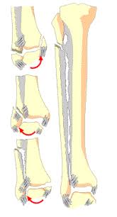 Der malleolus lateralis ist das verdickte ende des wadenbeins, das am oberen sprunggelenk beteiligt ist. Sprunggelenksbruch Knochelbruch Malleolarfraktur Fuss Sprunggelenk Orthozentrum Cham Zug Schweiz Orthopadische Chirurgie Dr Med Rolf F Oetiker