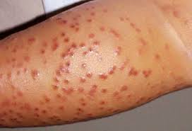 Poison ivy wouldn't really mimic herpes anyway; Viral Skin Conditions Pictures Of Rashes Blisters And Sores In Adults And Toddlers