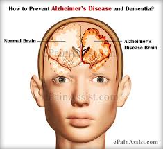 Wondering how to prevent alzheimer's? How To Prevent Alzheimer S Disease And Dementia