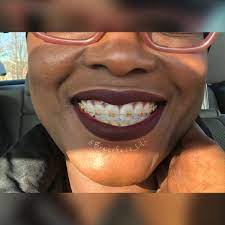 We've sold the cheaper braces for 3 years and have decided it's time for a jump up in quality so they can be. Mamacita Lipstick By Colourpop Cute Braces Braces Colors Teeth Braces