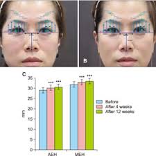 If the endoscopic forehead lift is a physiologic elevation, then the open forehead lift can be said to be a mechanical lift. Pdf Effect Of High Intensity Focused Ultrasound On Eyebrow Lifting In Asians