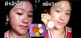 💥ເປີດຮ້ານຮັບເຊັດແລ້ວຈຮາສຸດດີຟ້າດີສິວ💞 💞ເຫັນຜົນໄນສຸດແລກແລ້ວເດີ້💞  ສົນໃຈຖາມໄດ້💞💥💥💥