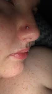 Check spelling or type a new query. Keloid Or Hypotrpoic Scar Help Asap Glow Community