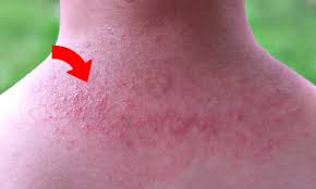 Petits boutons, démangeaisons et rhume des foins ! Bouton De Chaleur 6 Astuces Pour S En Debarrasser