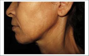 PDF] Reversible Facial Hyperpigmentation Associated With Vitamin B12  Deficiency.
