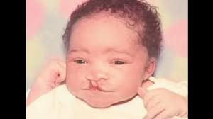 UNC docs awarded for cleft palate work