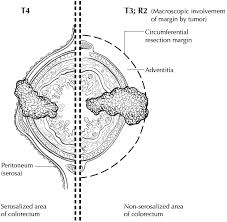 The pathologist looks at slides of the tumor under the microscope to see how close the cancer cells get to the ink (the edges or margins of the specimen). Https Documents Cap Org Protocols Cp Gilower Colonrectum 17protocol 4010 Pdf