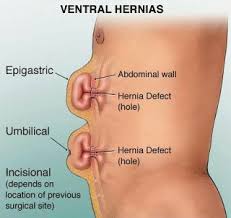 A hiatal hernia occurs when the upper part of your stomach bulges through the large muscle separating your abdomen and chest (diaphragm). 14 Hernia Ultrasound Ideas Ultrasound Sonography Medical Ultrasound