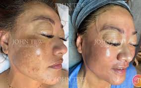 2 years of harsh treatments led to major discoloration. The after photo is  5 months of Bi-weekly sessions with me 🙌🏼 ✨ ✨ ✨ ✨ #brighten  #discoloration #spots #melasma #sculpting #facialsculpting  #lymphaticdrainage