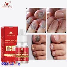 Essence bling bling nail stickers nálepky na nehty 28 kusů 32 kč. Plisnove Nail Repair Essence Serum Lecby Pro Peci O Nohy Nehty Oprava Nehtu Nehet Infekce Pece O Nohy Anti Infekce Zanet Nehtoveho Luzka Sleva Nehty Art Nastroje Www Vladana Kristena Cz