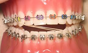 What are the treatment options for fixing overbite? Rubber Bands And Elastics For Braces