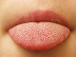 Swollen Tongue Symptoms Causes Treatments