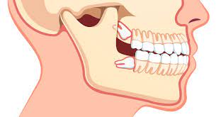 Designed to deep clean gums. 3 Warning Signs Of Impacted Wisdom Teeth Dr Suffoletta Dentistry