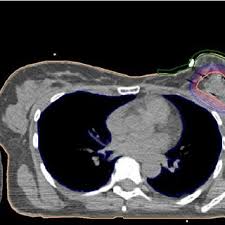 Areas commonly scanned for cancer include the head, neck, chest, abdomen, pelvis, or limbs. Breast Cancer A Ct Scan After Breast Conserving Surgery Before Download Scientific Diagram