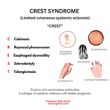 Image result for Systemic Sclerosis