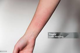 Image result for Dermatographism