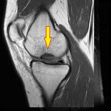 Maybe you would like to learn more about one of these? What Are The Options For Treating A Chondral Defect Of The Knee Caused By Sports Trauma Orthopaedia