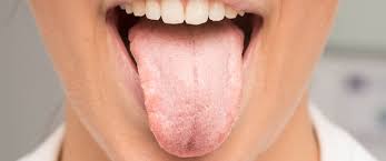 ان مرض السيلان يعتبر واحد من الامراض التي تنتقل عن طريق العلاقة الجنسية، وهو عادة ما ينقل عن طريق البكتيريا المعروفة بالنيسرية البنية، وهو عادة ما يكون على شكل حدوث بعض الالتهابات في الاغشية المخاطية التي تخص الجهاز التناسلي والاحليل، كما ان مرض السيلان يعتبر من الامراض الشائعة للغاية، كما انه يوجد حوالي 62 مليون شخص حول العالم سنويا. Ø£Ø³Ø¨Ø§Ø¨ Ø¹Ø¶ Ø§Ù„Ù„Ø³Ø§Ù† ÙˆØ·Ø±ÙŠÙ‚Ø© Ø¹Ù„Ø§Ø¬Ù‡ ÙˆÙŠØ¨ Ø·Ø¨