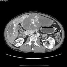 When it comes to screenings like mris and ct and pet scans, you've got choices. Peliosis Hepatis Radiology Imaging Radiology Radiography