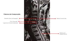 Estenose de Canal Cervical: Causas, Tipos e Tratamentos - Dr. William Zarza