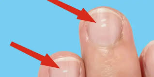 Walaupun bisa disebabkan karena manicure, namun tanda putih itu tak boleh diabakan. Larissa Aesthetic Center