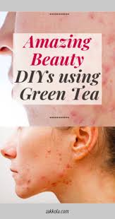Pin On Acne Remedies