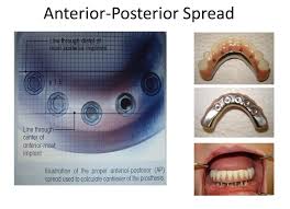 We did not find results for: Hybrid Denture Protocol And Procedures For Successful Case Outcome What S In Your Mouth