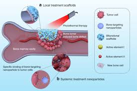 Although for many women undergoing surgery for early breast cancer the outlook is excellent, with an average 5 year survival of 91% in australia, it is essential that all patients with invasive breast cancer are made aware of the possibility of subsequent. Review Of A New Bone Tumor Therapy Strategy Based On Bifunctional Biomaterials Bone Research