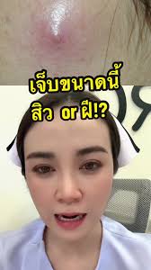 ฝี หรือ สิว: รู้เรื่องการแยกแยะ